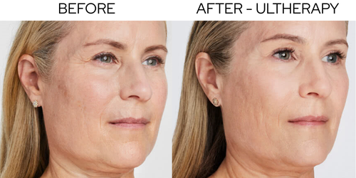 Ultherapy results