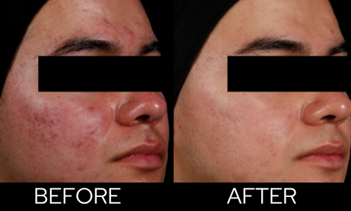 AviClear before and after
