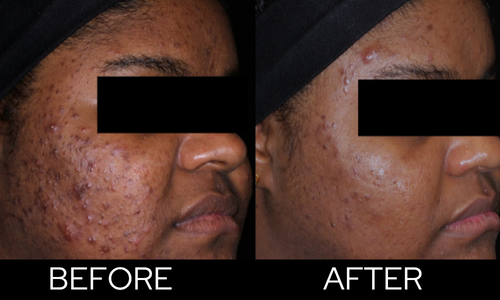 AviClear before and after
