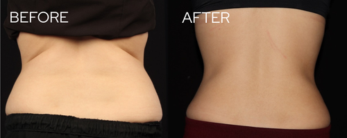 Coolsculpting results