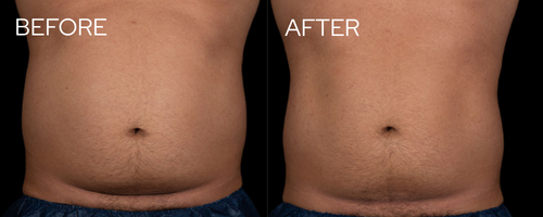 truSculpt flex results